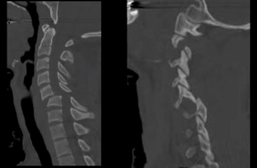CT Scan, cervical facet dislocation and fracture